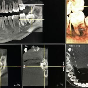 Digitale Volumentomographie Weisheitszahn